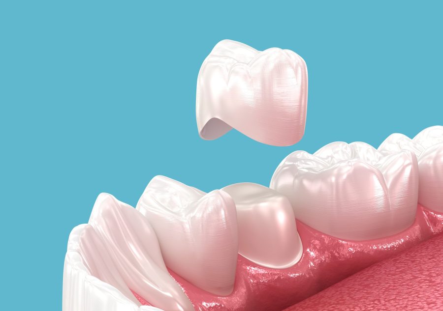 Transform Your Smile with the Benefits of Dental Crowns Vancouver, WA