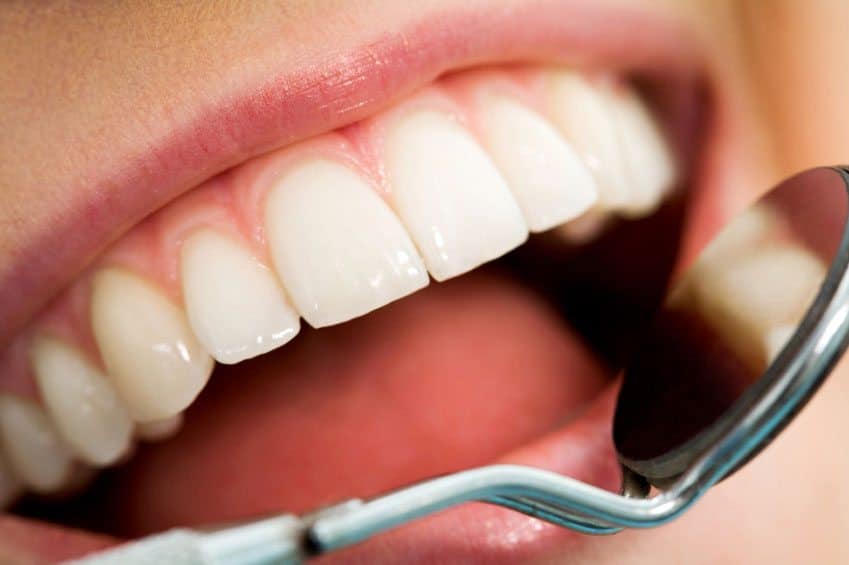 Teeth Whitening Basics